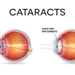 cataracts-diagram2