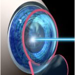 Laser-Lasik-Bladeless-Eye-Surgery