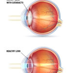 cataracts-diagram