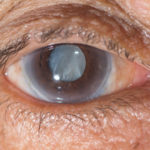 cataract-eval-header