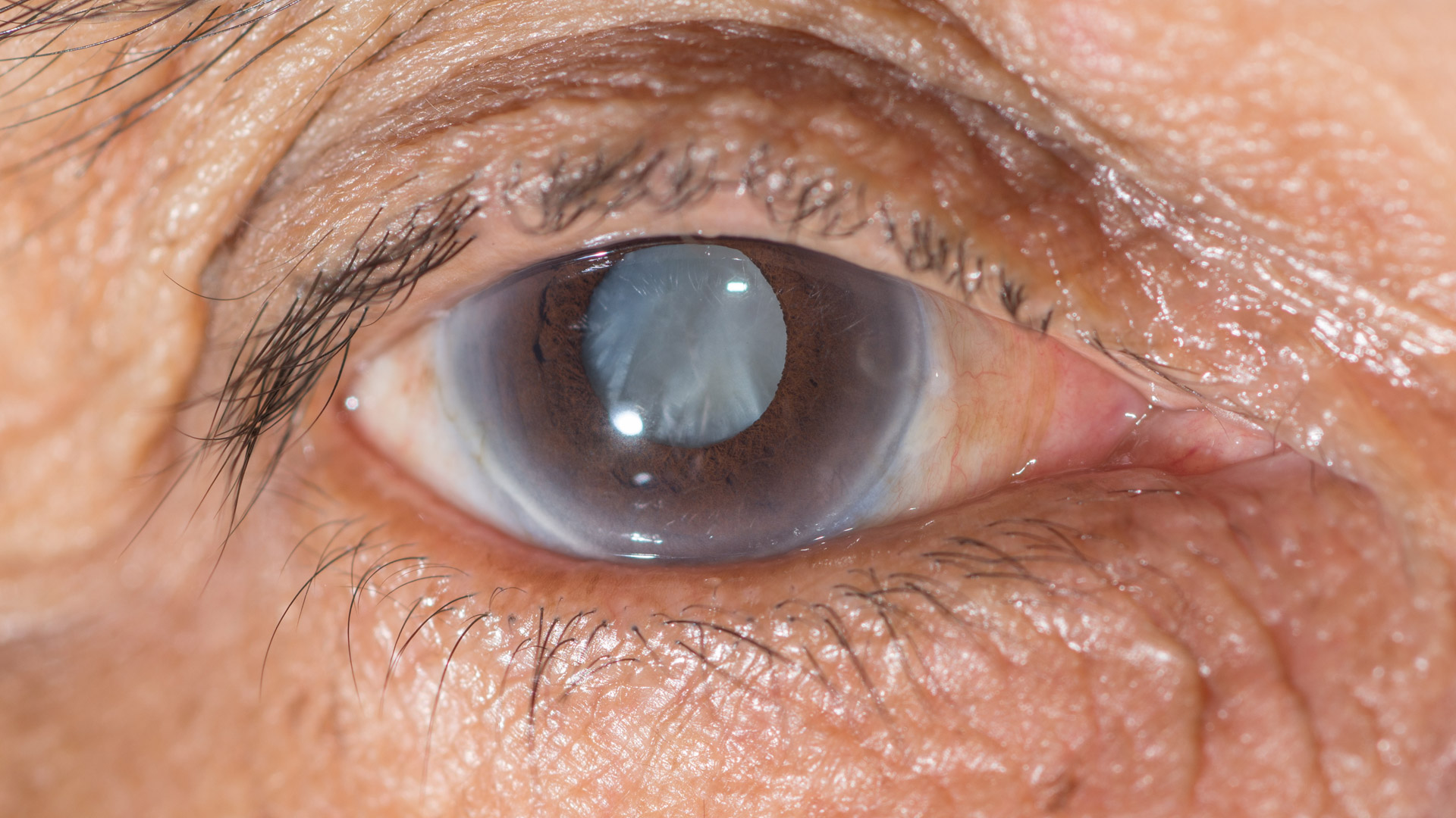 Do Cataracts Cause Floaters And Flashes