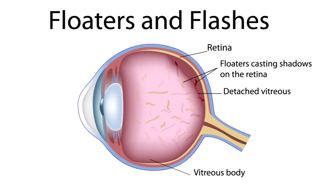 FLASHES AND FLOATERS PghEyeMeds