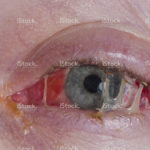 stock-photo-9453531-pink-eye-after-surgery