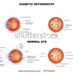stock-photo-diabetic-retinopathy-on-a-white-background-detailed-anatomy-the-eye-condition-that-affect-people-327794945