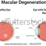stock-vector-macular-degeneration-204423757