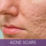 condition-acne-scars