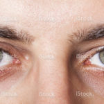 stock-photo-53964560-irritated-red-bloodshot-eye