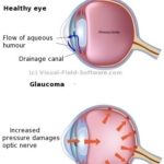 xvisual-field-test-development-of-glaucoma.jpg.pagespeed.ic.Y5ck3-nI6s
