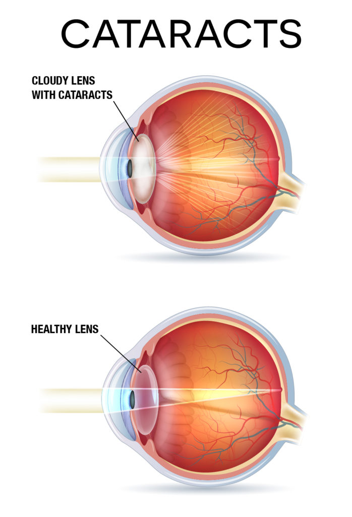 cataracts-diagram