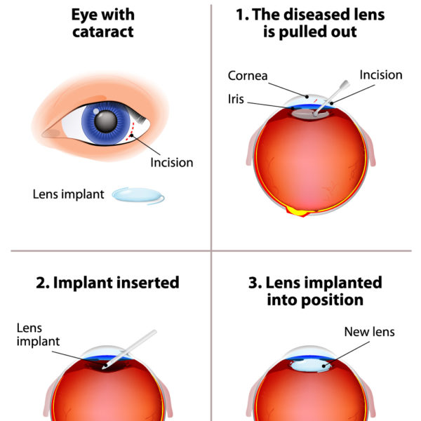 Cataracts diagram PghEyeMeds Cataracts diagram PghEyeMeds