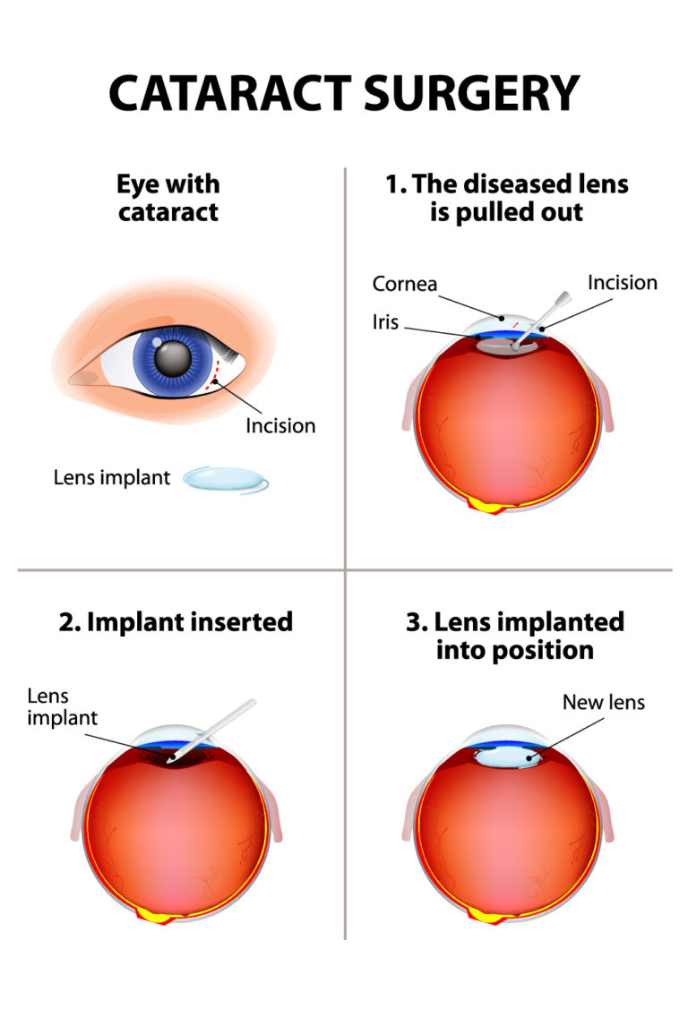 Does Medicare Pay For Eyeglasses Following Cataract Surgery at Tonya