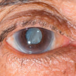 cataract-featured-image