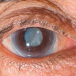 cataract-home-conditions