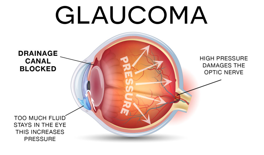 glaucoma-diagram