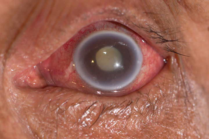 glaucoma-featured-image