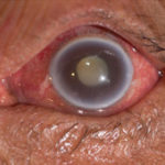 glaucoma-home-conditions