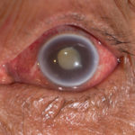 glaucoma-header