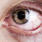 stock-photo-16982142-blood-capillary-human-eye