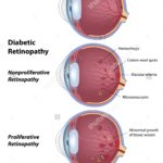 stock-photo-diabetic-retinopathy-eye-disease-due-to-diabetes-90457306
