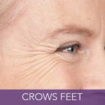 condition-crows-feet