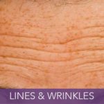 condition-lines-wrinkles