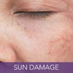 condition-sun-damage